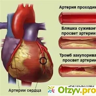 Ишемическая болезнь сердца вызвана