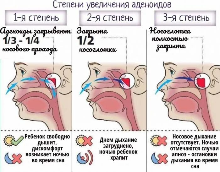 Аденоиды признаки