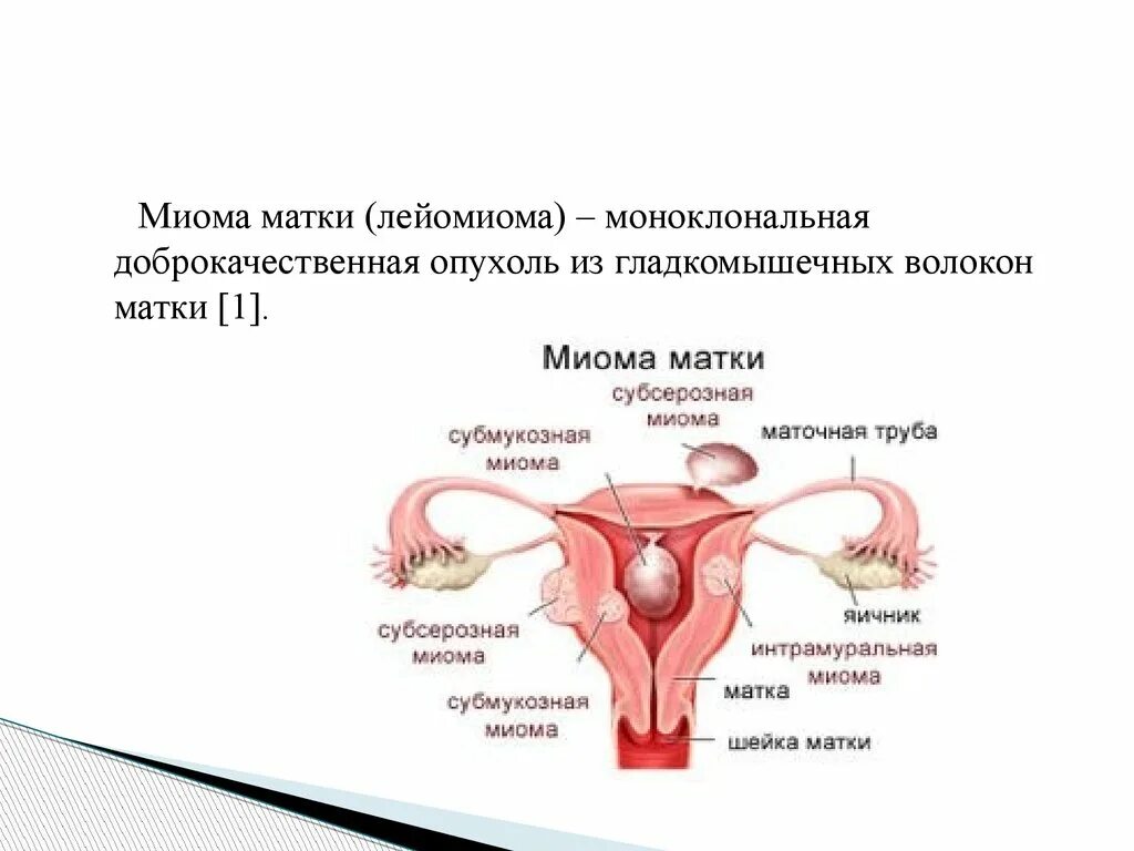 Формы миомы матки. Лейомиома маточной трубы.