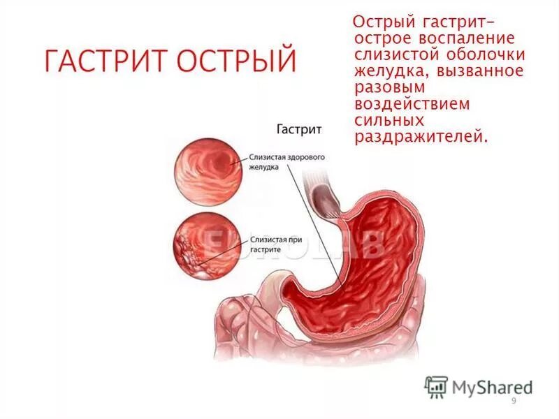 Гастрит воспаление слизистой оболочки. При остром гастрите в слизистой оболочке желудка развивается. Гастрит слизистой оболочки желудка воспаление. Разновидности гастритов острый и хронический. Слизистой оболочки желудка признаки