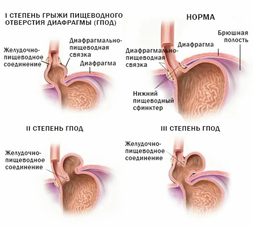 грыжа желудка пищеводного отверстия диафрагмы. грыжа пищеводного желудка. фундальная грыжа пищеводного отверстия. грыжа пищевода у женщин. грыжа пищевого отдела диафрагмы.