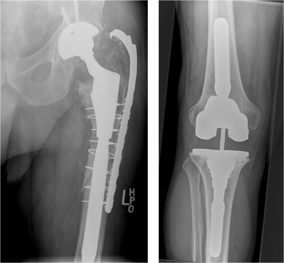 ТБС тазобедренного сустава. Эндопротез бедренной кости. Эндопротезирование коленного сустава рентген. Остеосинтез плечевого сустава. Была операция по замене тазобедренного сустава