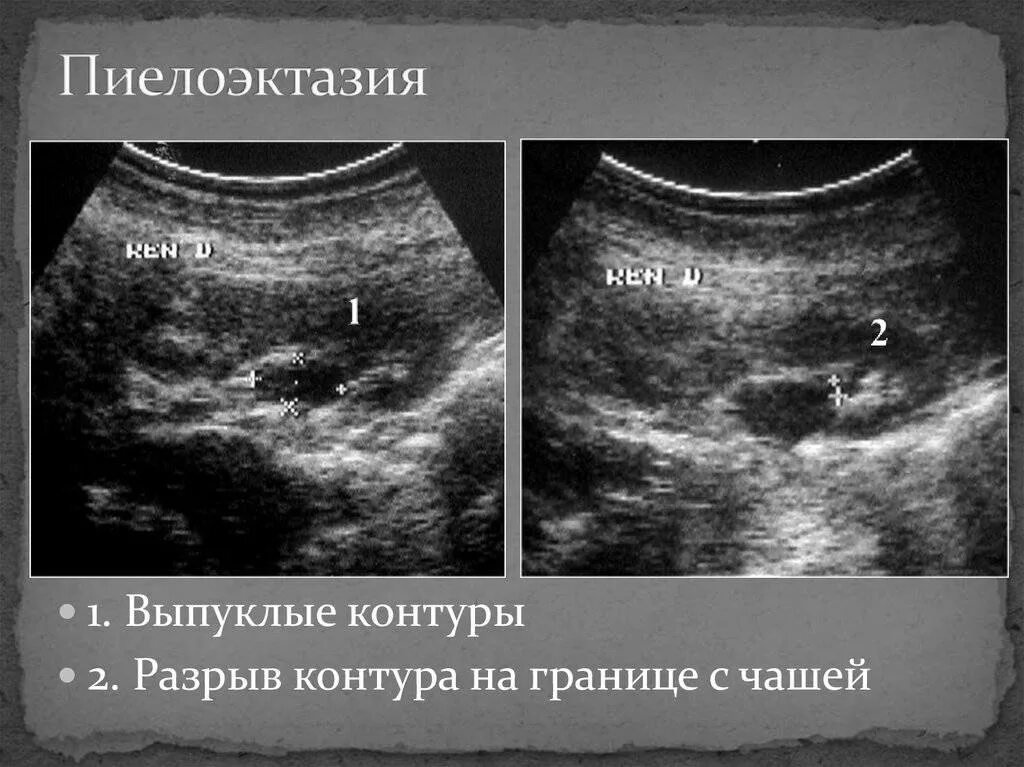 Расширение лоханки почки пиелоэктазия. Пиелокаликоэктазия почки на УЗИ. Чашечки почек УЗИ пиелоэктазия. УЗИ признаки пиелоэктазии.