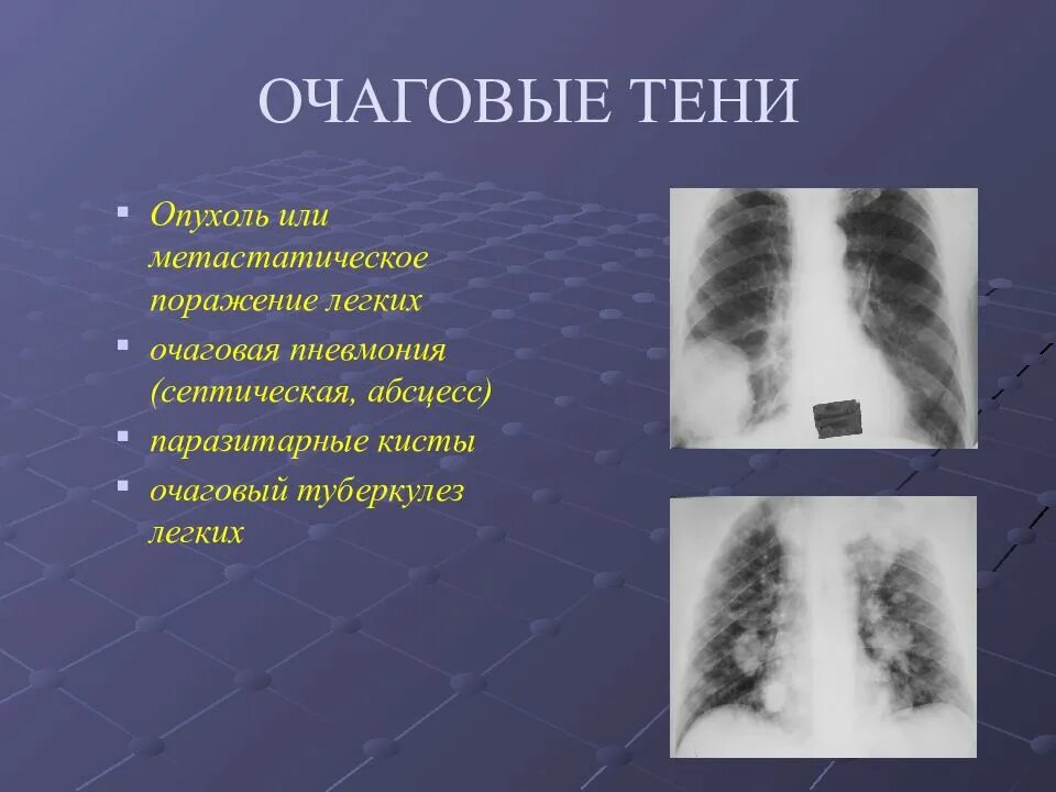 Очаговая тень. Очаговые тени в легких. Очаговое поражениелегокго. Очаговые тени в легких на рентгене.