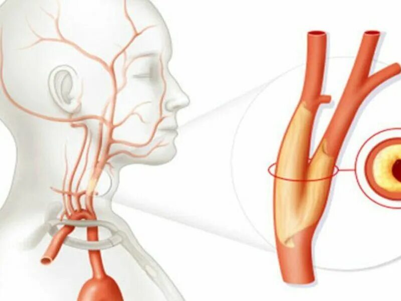 Окклюзия сонной артерии. Операция на сосуды шеи при стенозе. Сужение шейных сосудов