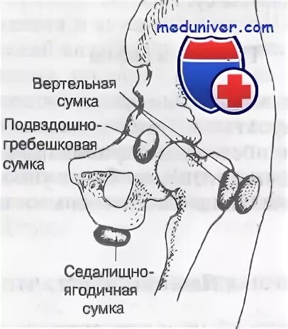 Седалищный бурсит тазобедренного сустава лечение