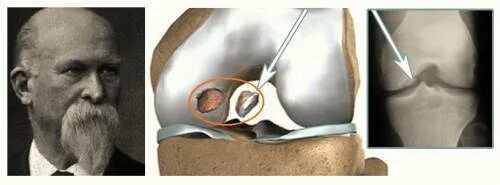 остеохондрит коленного сустава. рассекающий остеохондрит коленного сустава рентген. кенига болезнь коленного сустава на рентгене. рассекающий остеохондрит коленного сустава. болезнь суставов кенига.