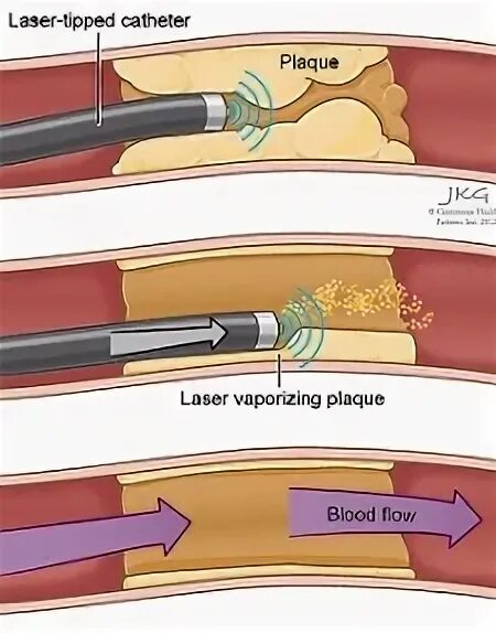 Чистка тромба. Лазерная ангиопластика сосудов. Лазерная ангиопластика сосудов нижних конечностей. Лазерная коронарная ангиопластика. Эксимерная лазерная ангиопластика коронарных сосудов.