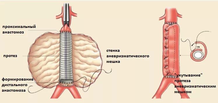 Аневризма аорты какие операции. Линейное протезирование аорты. протезирование брюшной аорты. аневризма брюшной аорты протез.