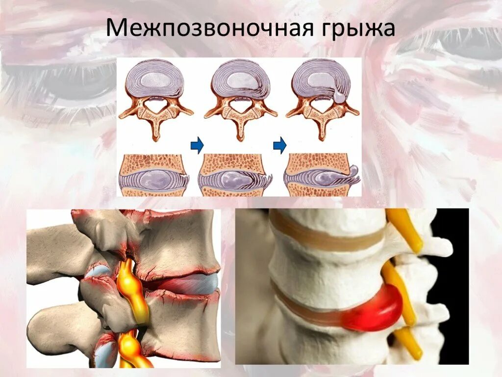 Грыжи дисков поясничного отдела позвоночника. Межпозвоночная грыжа грыжа поясничного отдела. Грыжа диска позвоночника поясничного отдела. Грыжа дисков позвоночника что это такое.