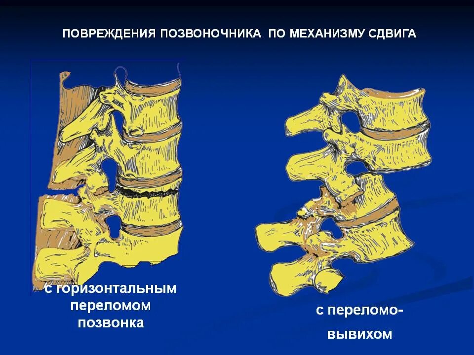 Поврежденияпозвоночник. Механизмы повреждения позвоночника. Механизм перелома позвоночника. Переломовывихи позвонков.