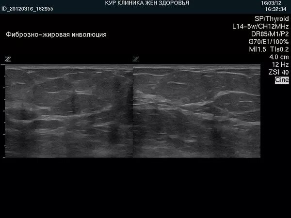 Мультицентрическая опухоль молочной железы. Снимки маммографии молочных желез в норме. Фиброзно-жировая инволюция маммография. Фиброзно жировая трансформация. Фиброзно жировая трансформация.