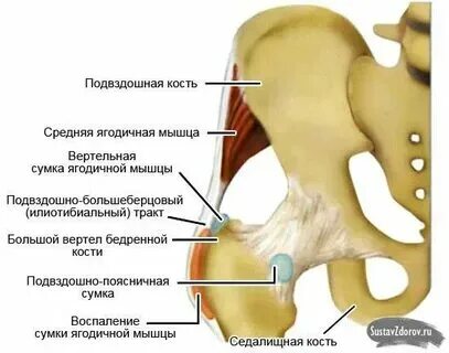 Бурсит трохантерит тазобедренного сустава. Трохантерит тазобедренного сустава рентген. Трохантерит тазобедренного код мкб. Трохантерит сухожилия бедра. Трохантерит тазобедренного мрт.