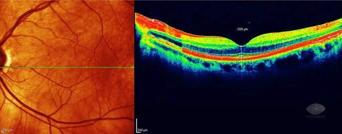 Макулярный разрыв после операции. Ламеллярный макулярный разрыв сетчатки. Окт макулы норма. Макулярный разрыв сетчатки ОСТ. Макулярный разрыв окт.
