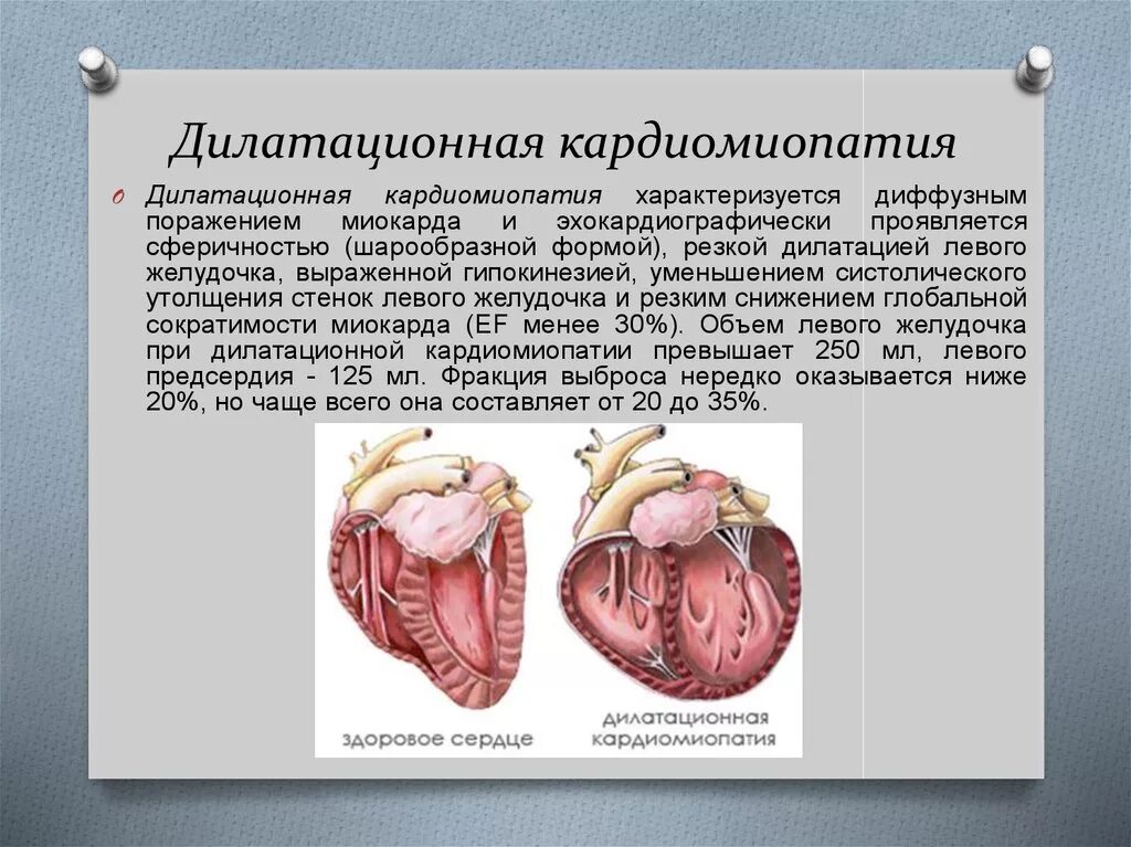 Диффузная сердца. Кардиопатия дилатационная кардиомиопатия. симптомы дилатационной кардиомиопатии. форма сердца при дилатационной кардиомиопатии. осложнения ибс дилатационная кардиомиопатия.