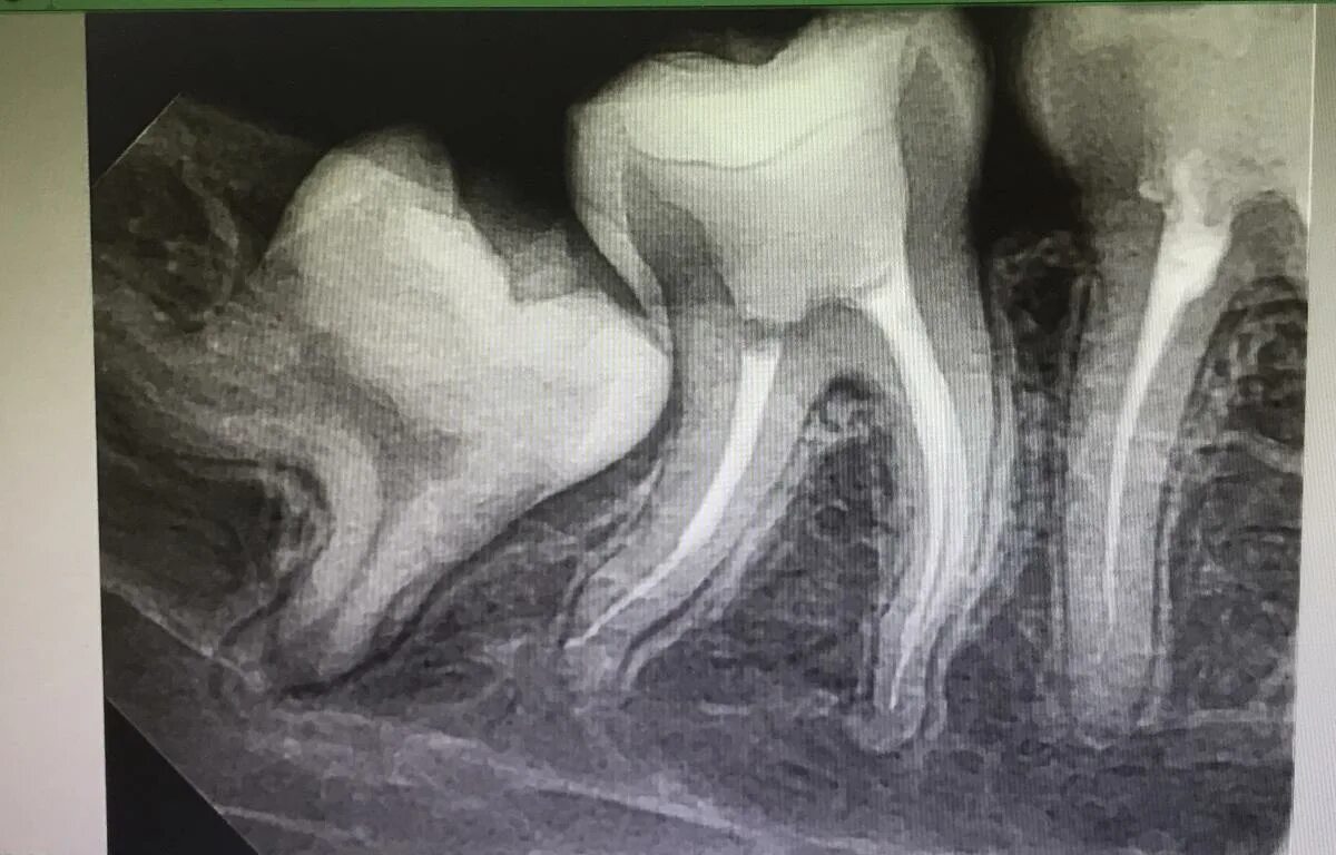 Пломбировка корневых каналов. Перепломбировка каналов зуба рентген. Пломбировка каналов зуба.