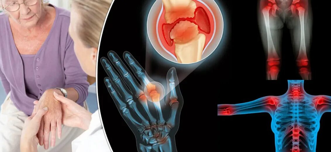 Пациент с остеоартрозом. Инфекция суставов. Суставы. Ревматоидный полиартрит на коленном суставе. Суставные заболевания.