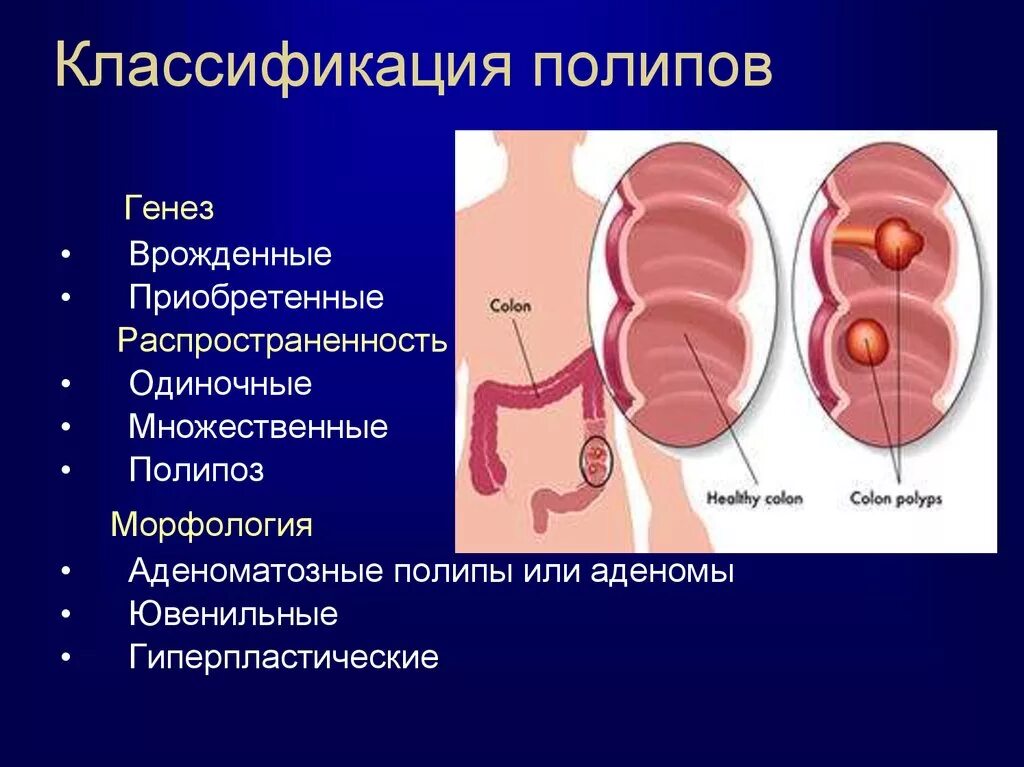 Ворсинчатый аденоматозный полип. Типы полипов толстой кишки классификация. Полипы прямой кишки классификация. Полипоз ободочной кишки классификация. Эпителиальное образование желудка что это