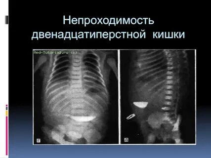 Высокая кишечная непроходимость у детей