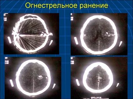 Ран мозга