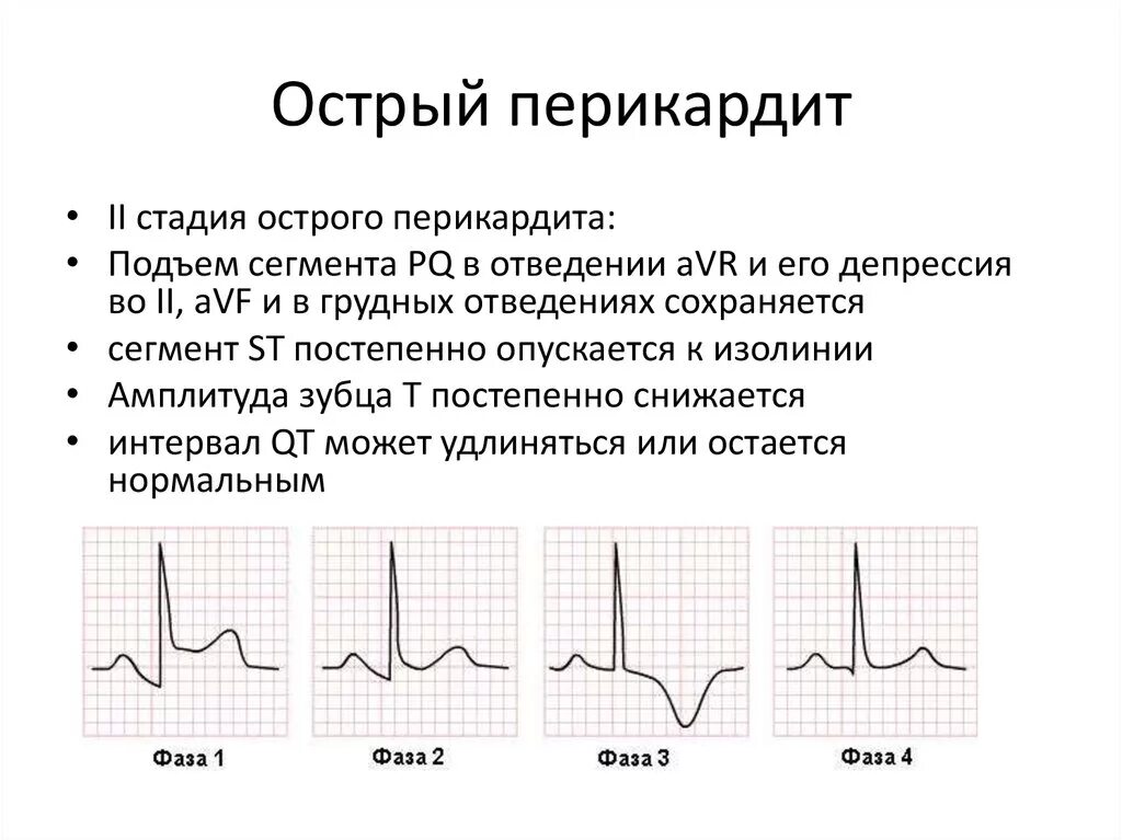 Депрессия сегмента st. Подъем сегмента St на ЭКГ v3. Элевация сегмента St и перикардит. Корытообразный сегмент St на ЭКГ. Элевация сегмента St на ЭКГ перикардит.