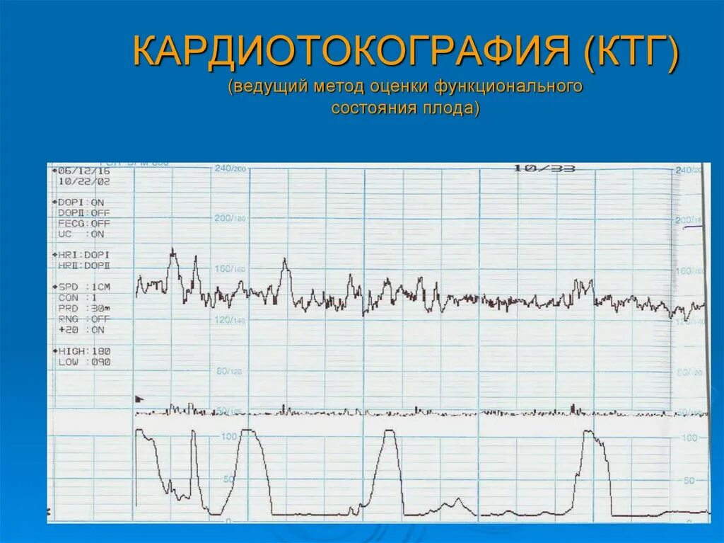 Исследование сердцебиения плода. Кардиография КТГ плода. КТГ нормальный Тип Кривой. Патологический Тип КТГ плода.