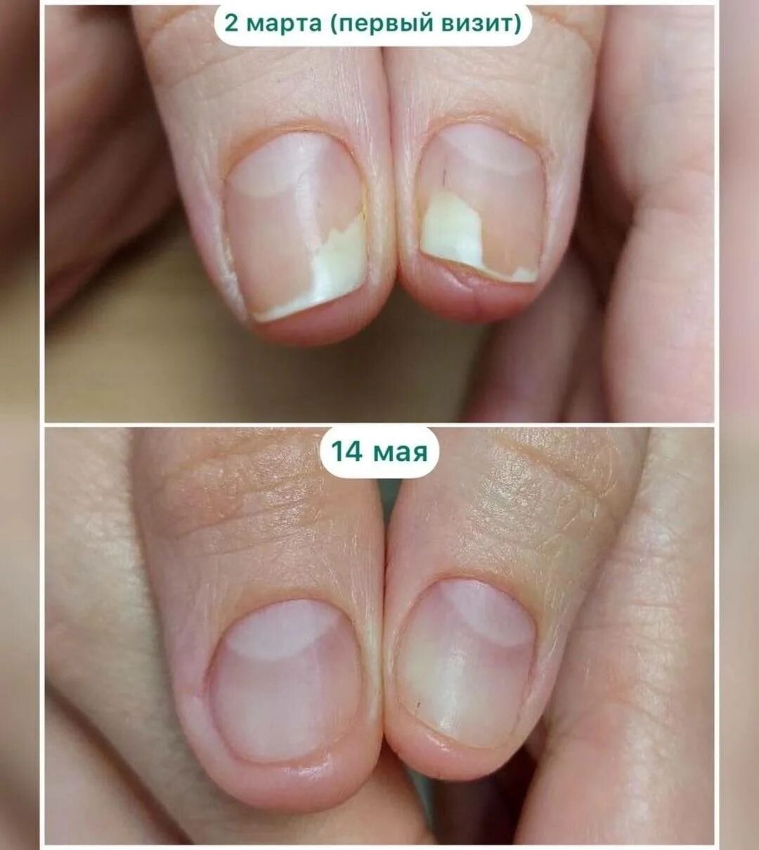 Восстановление сломанного ногтя. Ремонт ногтя. Ноготь ломается сбоку. Ноготь ломается сбоку. Ремонт ногтя.