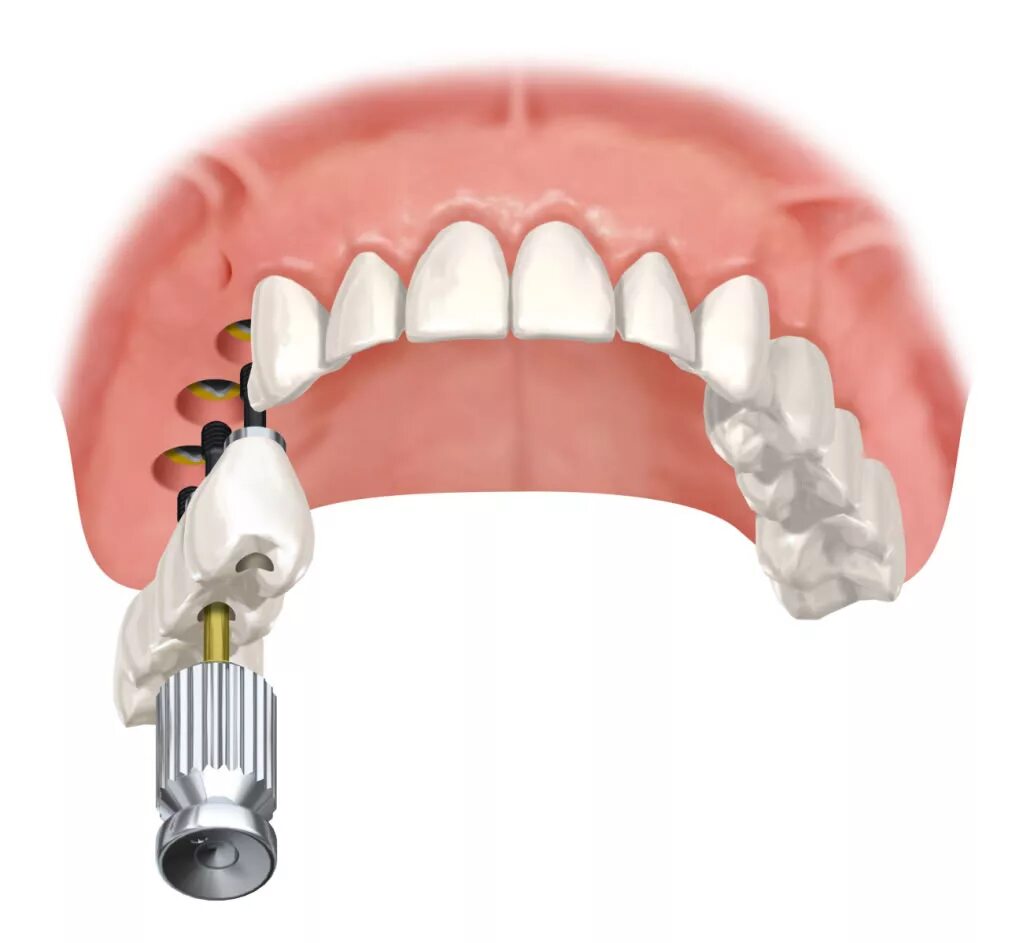 Трансгингивальная имплантация. Трансгингивальная имплантация зубов. Базальная имплантация зубов верхней челюсти. Имплант 4 зуба верхней челюсти.