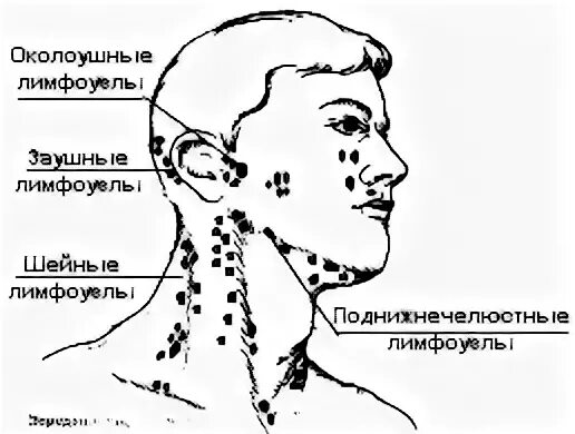 Шейные лимфоузлы схема. Шейные лимфоузлы расположение схема. Схема расположения шейных лимфоузлов. Подчелюстные лимфатические узлы схема. Преаурикулярные лимфоузлы
