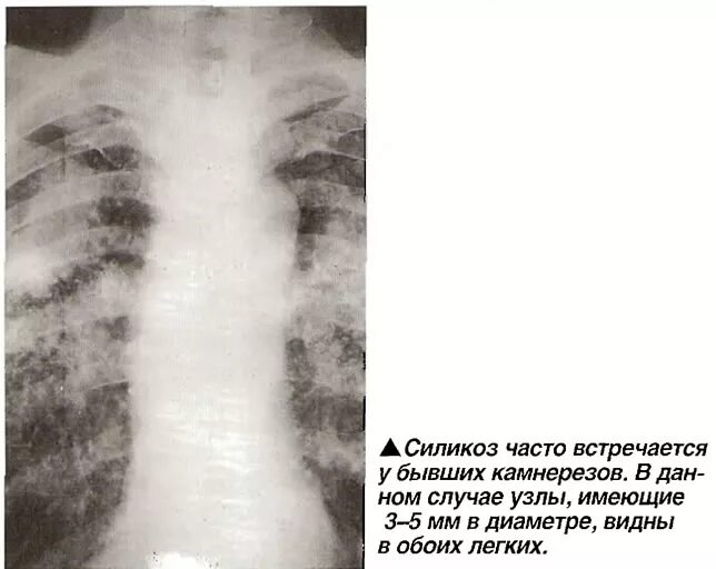 Силикоз легких что это симптомы лечение. Силикоз легких что это симптомы лечение. Силикоз кт. Силикоз легких что это симптомы лечение. Силикоз легких что это симптомы лечение.