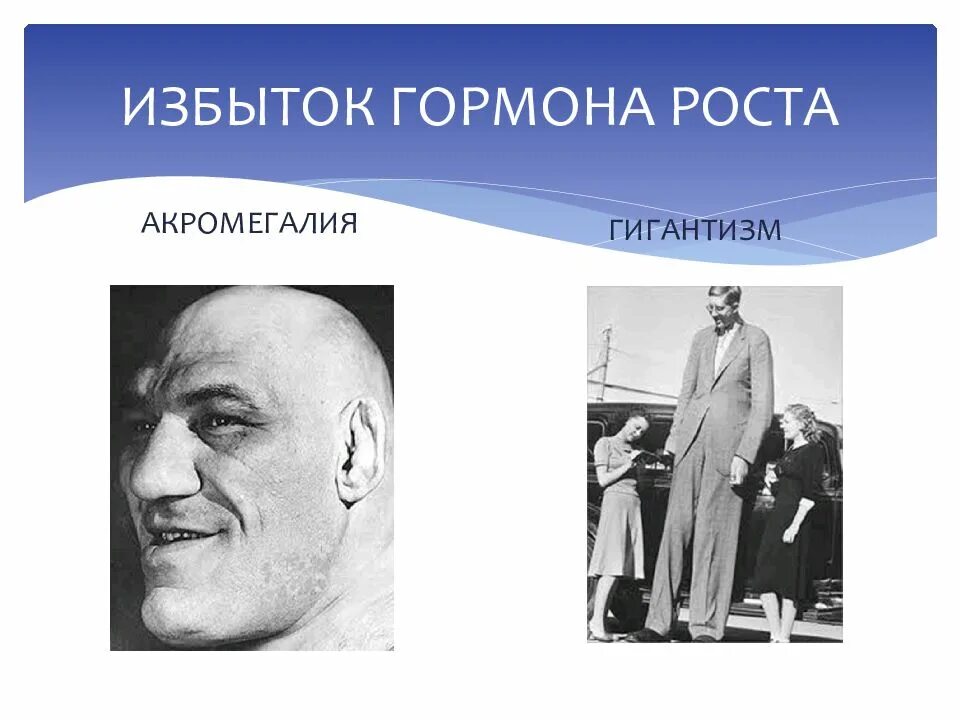 Заболевание гормона роста. Соматотропин акромегалия. Соматотропин гигантизм акромегалия. Гигантизм избыток гормона. Переизбыток гормона роста.