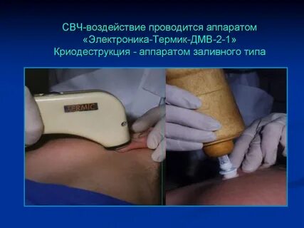 Метод микроволнового воздействия
