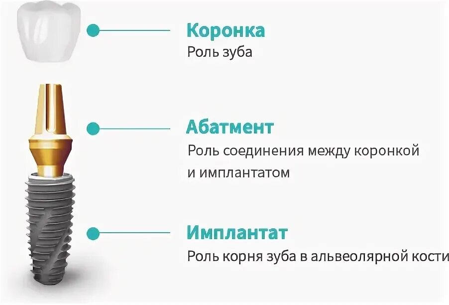 Чем отличается имплант от коронки