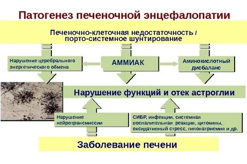 Энцефалопатия при циррозе
