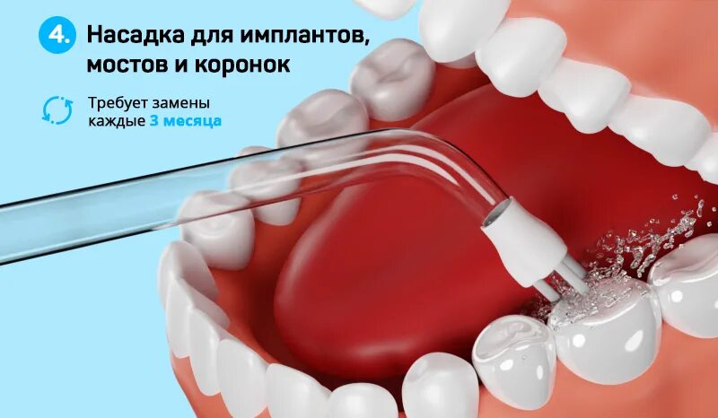 Ирригатор ves electric vip-005. Ирригатор в хирургии. Лучший ирригатор для имплантов. Насадка для ирригатора для имплантов. Ирригатор travola fl-v8.