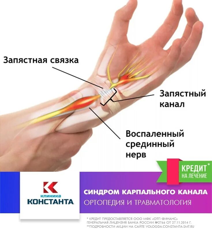 Туннельный карпальный синдром руки. Туннельный синдром карпального канала. Карпальный туннельный синдром запястья операция. Синдром карпального канала кисти. Синдром карпального канала мкб 10