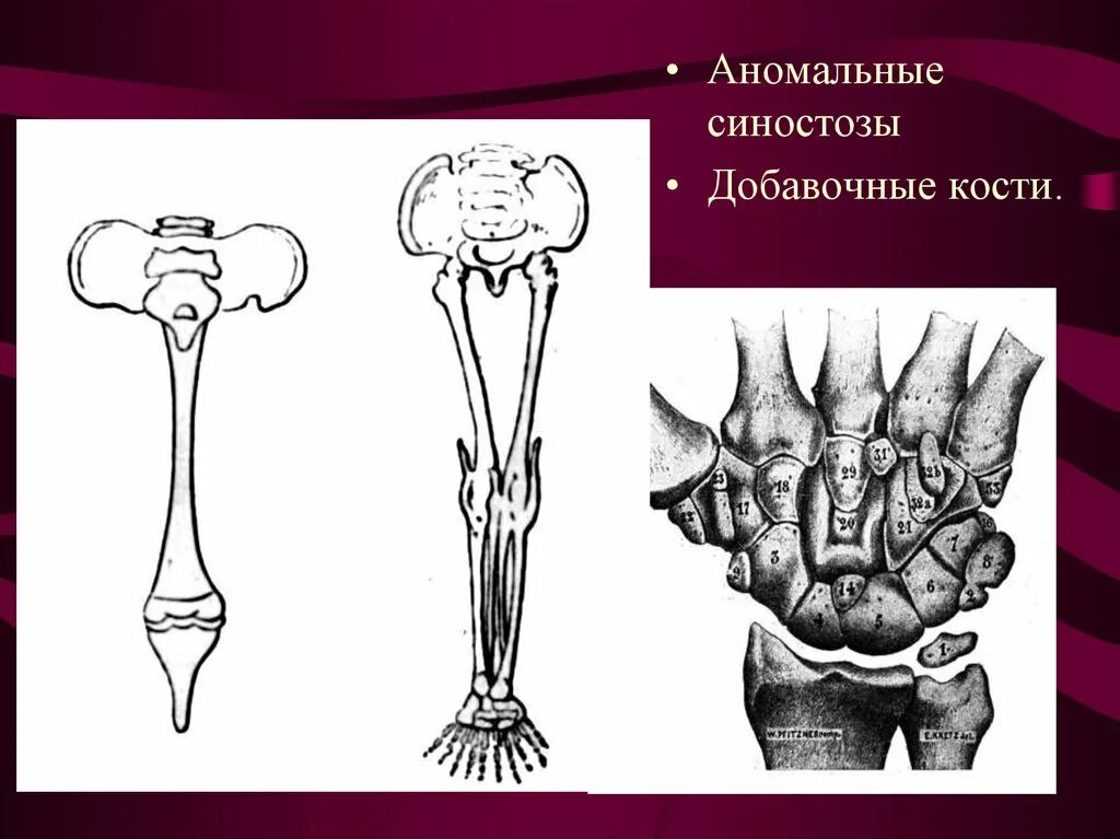 Аномалии костей. Аномалии развития костей. аномалия костей конечностей. синостоз 1 пястных костей.