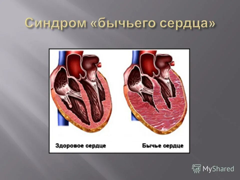 бычье сердце диагноз у человека что это