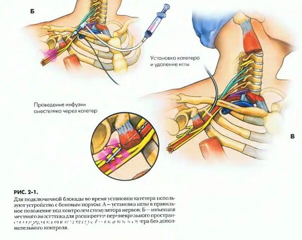 Нервная блокада. Блокада диафрагмального нерва. Шейная блокада проводниковая анестезия. Блокада аксиллярного нерва. Катетеризационные методики блокады нервов.