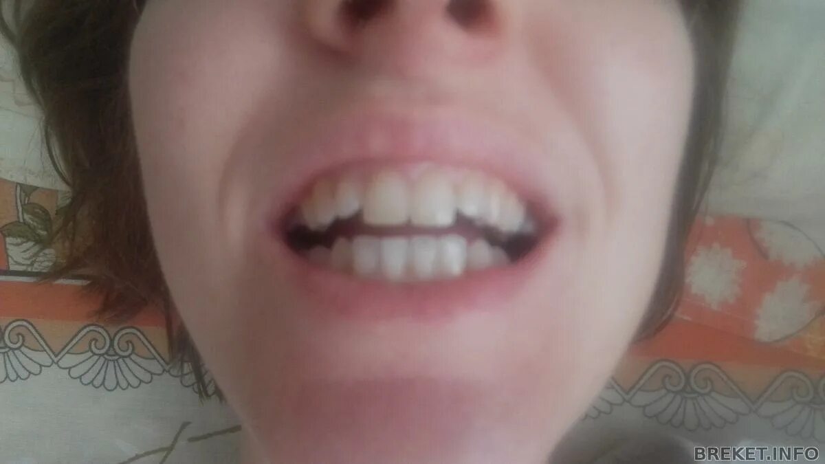 Два передних зуба выпирают вперед. Два передних зуба. Не ровние передние зубы. Имплантация зубов до и после. Идеально ровные зубы.