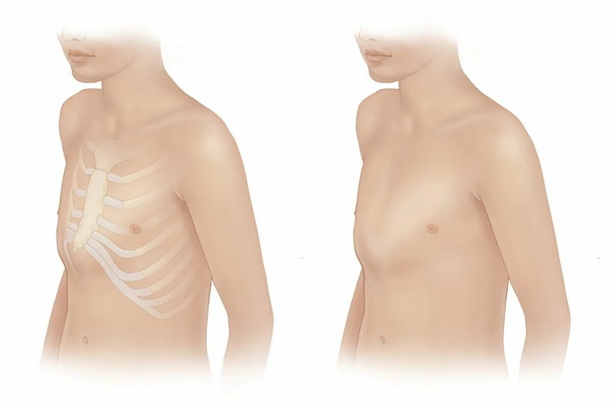 Килевидная деформация грудной клетки. Клювидное деформация грудное клетке. Килейная грудная клетка. Грудная клетка ребенка 2 года