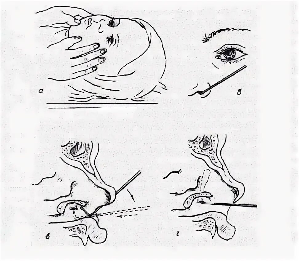 Как пробивают слезный канал. Дакриоцистит зондирование канала. Зондирование слезного канала у детей. Дакриоцистит у новорождённого зондирование. Техника массажа слезного канала у грудничка.