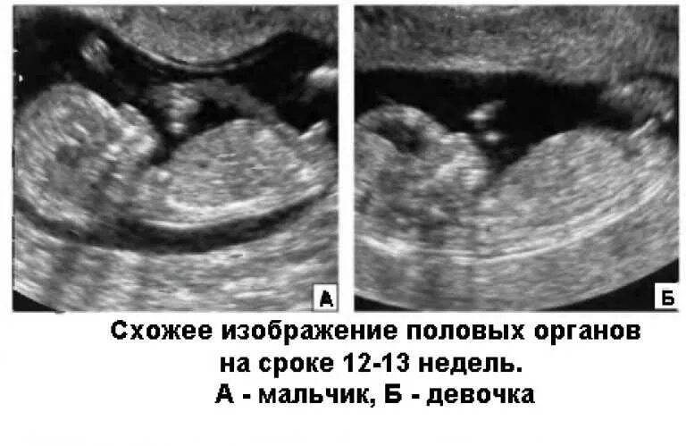 Как отличить на узи