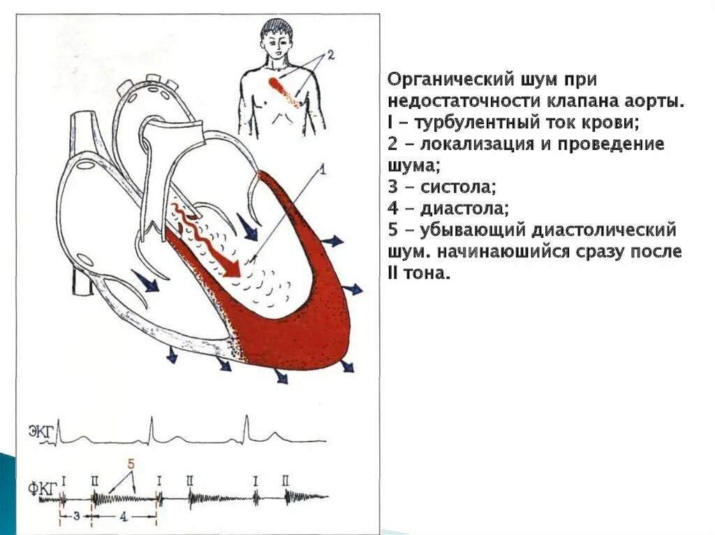 Недостаточность аортального клапана аускультация. Шум митральной недостаточности экг. Аортальнвй стеноз аксеклттауия. При аортальной недостаточности выслушивается шум. Аортальные шумы.