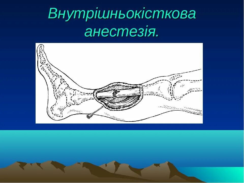 Обезболить место перелома. Местное обезболивание при переломах. Обезболивание места перелома. Обезболить место перелома. Анальгетики при переломах.