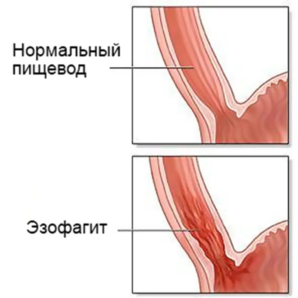 Пищевода тошнота