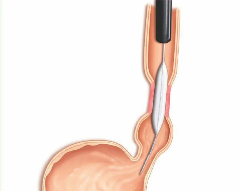 Стеноз пищевода бужирование. Стеноз пищевода - бужирование пищевода. Баллонная кардиодилатация пищевода.