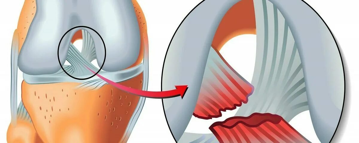 Разрыв связок врач. Разрыв передних крестообразных связок. Разрыв крестообразной связки коленного сустава. Разрыв ПКС коленного сустава. Растяжение передней крестообразной связки.