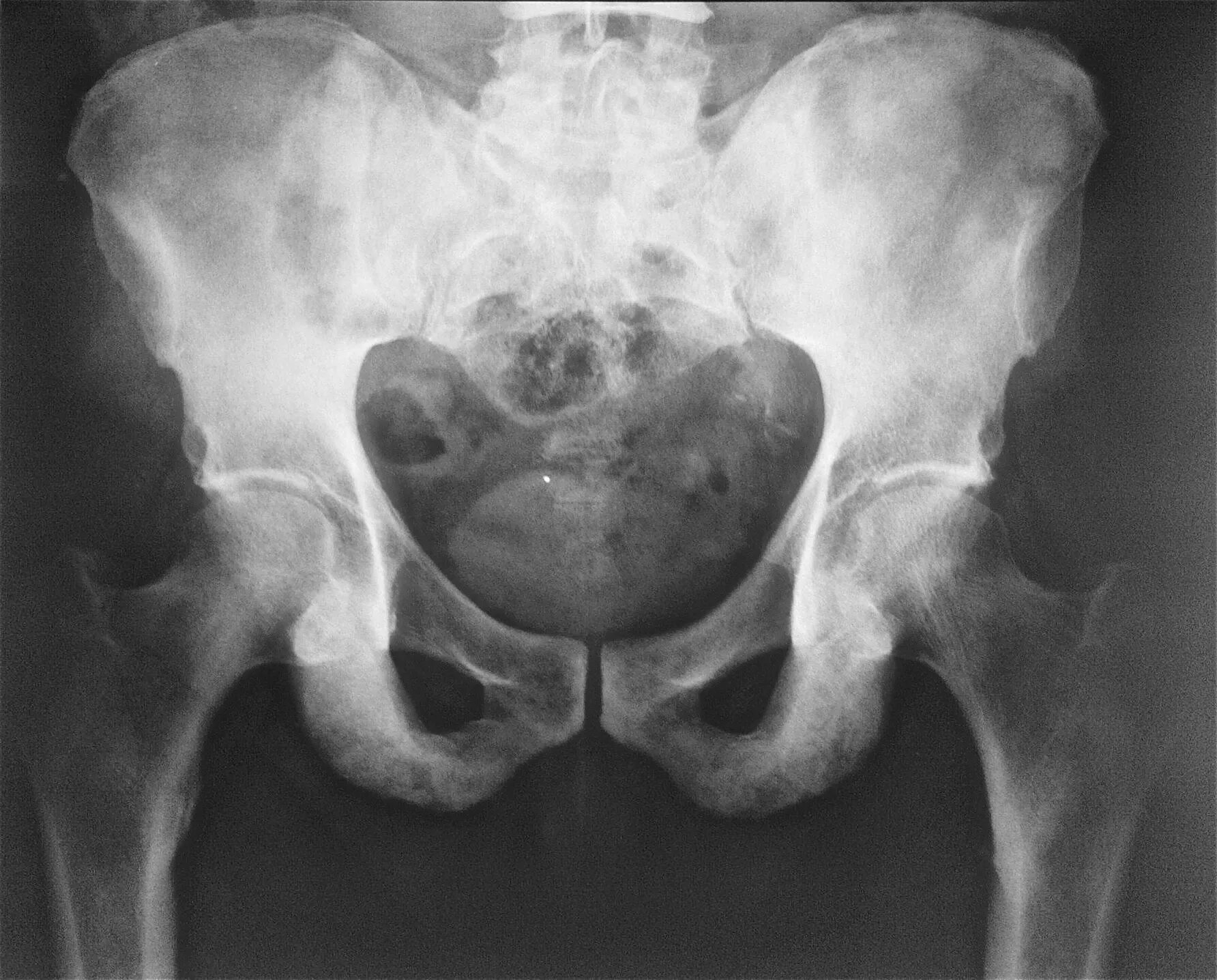 рентген снимки таза