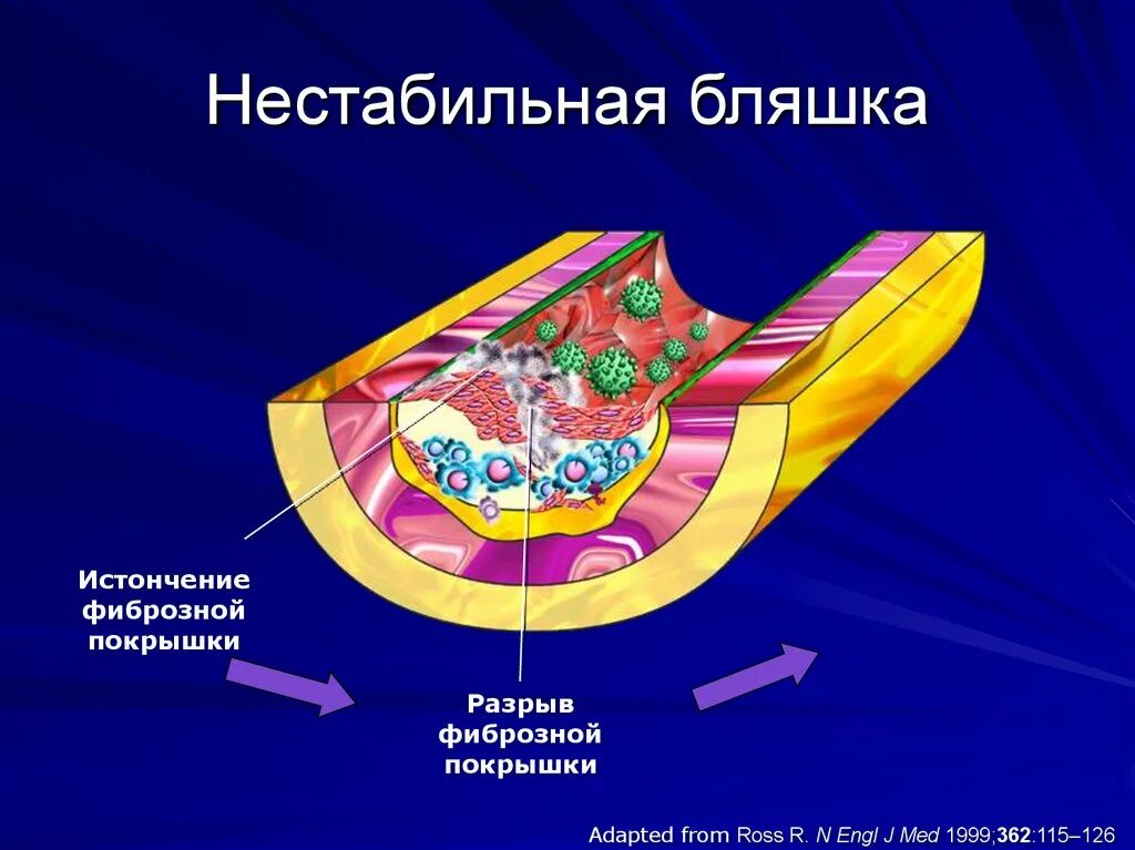 Разрыв бляшки. Нестабильная атероматозная бляшка. Холестериновая бляшка строение. Строение атеросклеротической бляшки.